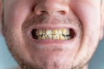 Nicotine stains, Nicotine stains latest, are nicotine stains on your teeth irreversible, Teeth