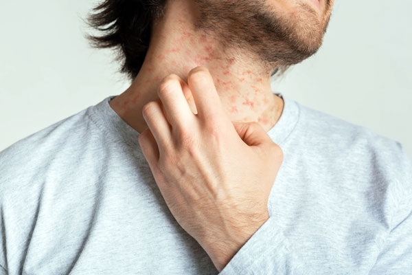 Tips to cure Skin Diseases like Rashes and Itching
