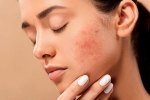 dermatologist, acne, 10 ways to get rid of pimples at home, Beauty products